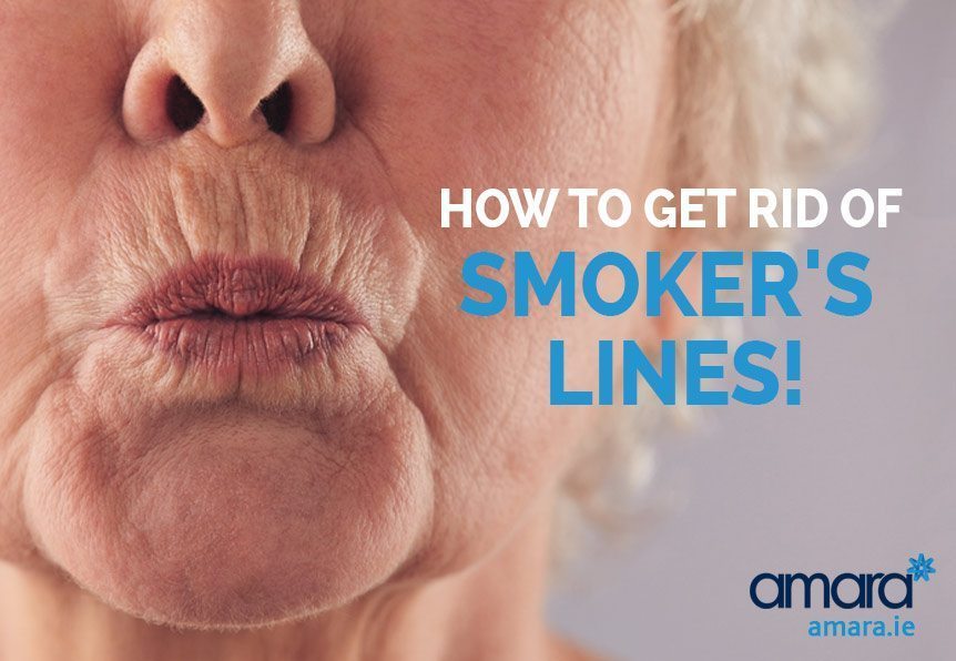 How To Get Rid of Smokers Lines
