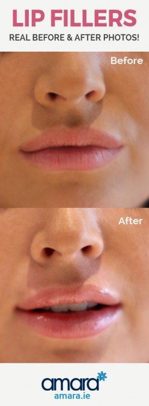 Lip Fillers Dublin - Before and After photos