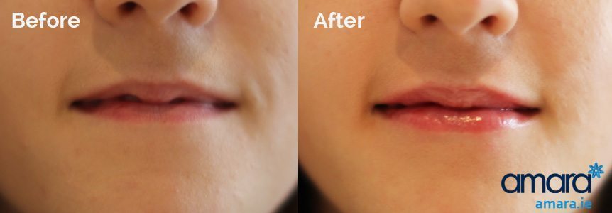 Lip Fillers Plumper Treatment Dublin - Amara