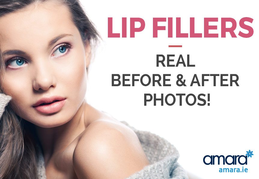 Lip Fillers - Real Before and After Photos - Amara Dublin