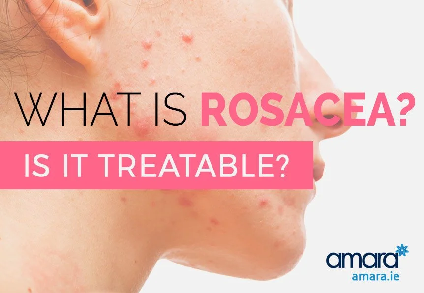 What is Rosacea How to treat Rosacea