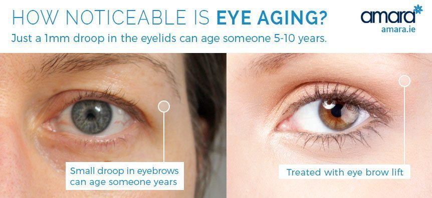 how noticeable is eye aging