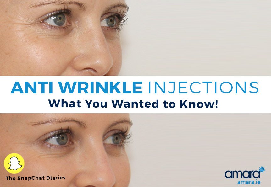 Anti Wrinkle Injections Dublin - Anti Wrinkle Injection FAQ
