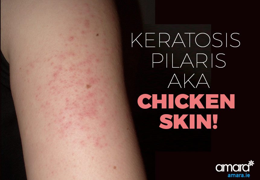 Keratosis Pilaris aka Chicken Skin