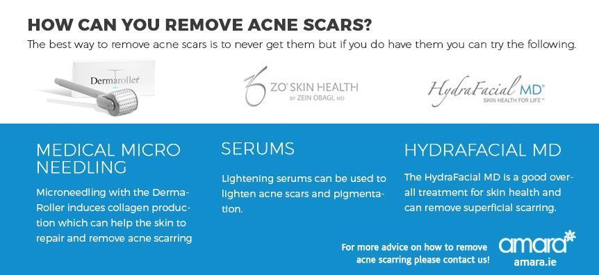 how can you remove acne scars?