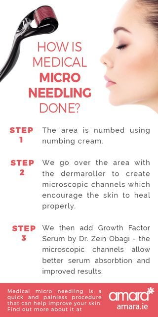 How is Medical Micro Needling Done?