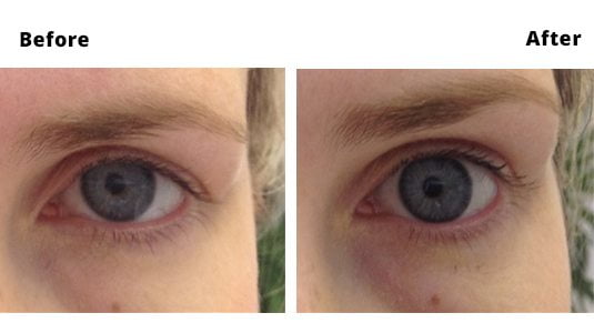 Brow Lift Before and After Brow Lift Treatments Dublin Amara