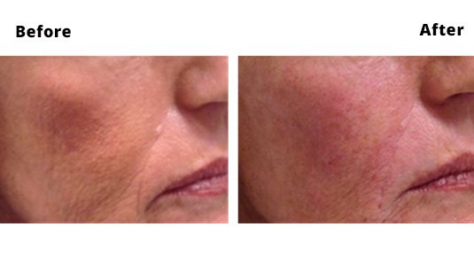 Cheek Fillers Dublin | Face Lifts & Liquid Cheek Lift Treatments