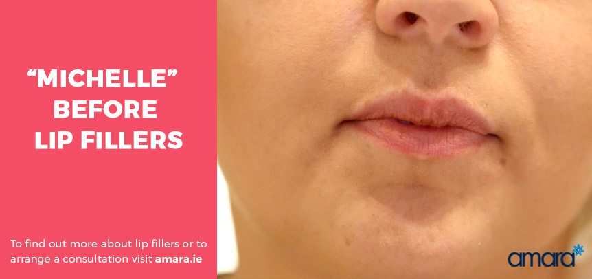 Before Lip Fillers - Amara Clinics Dublin