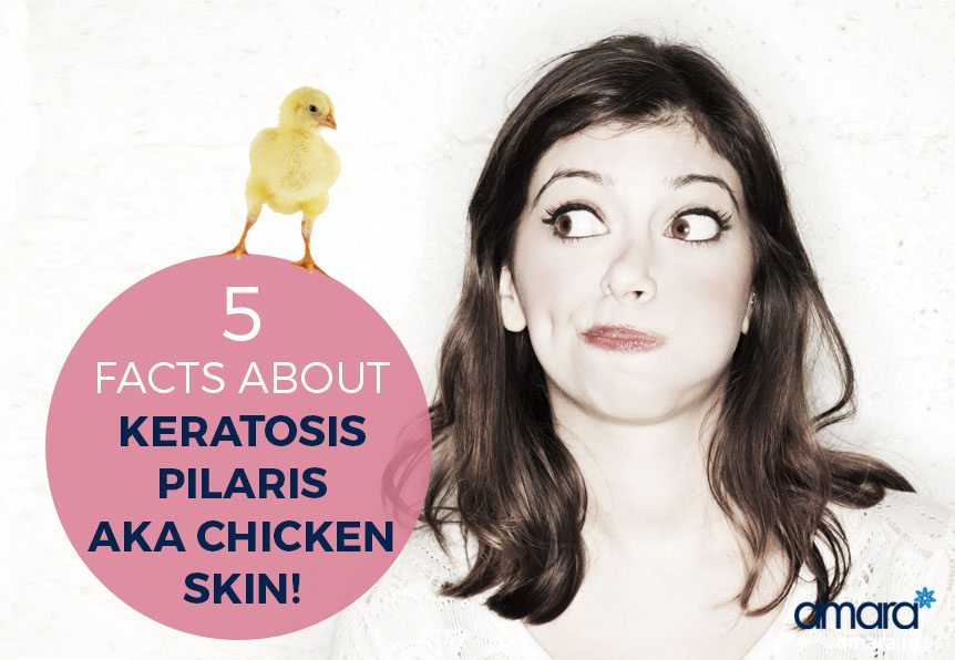 Keratosis Pilaris Facts - AKA Chicken Skin
