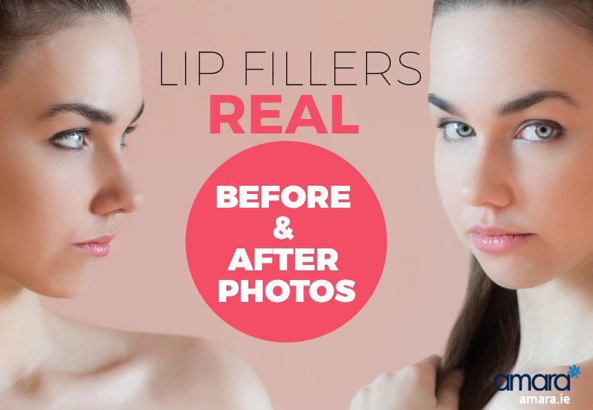 Lip Fillers Real Before and After Photos