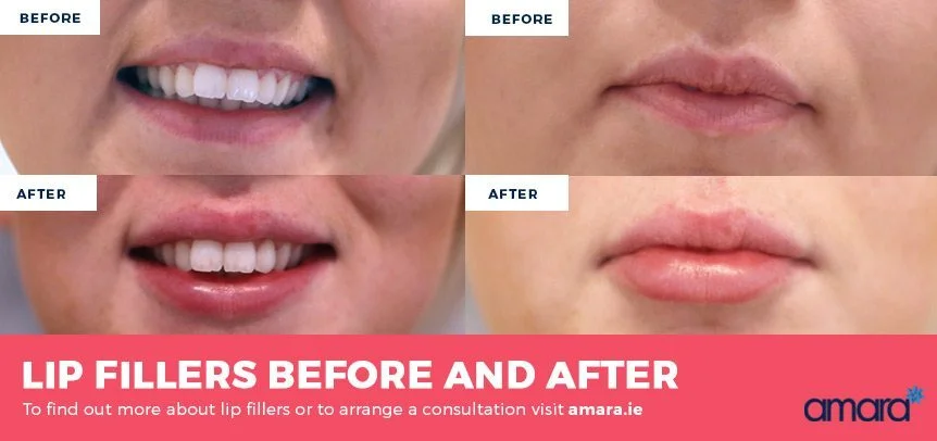 Lip Injections - Real Before and After Photos - Amara Dublin