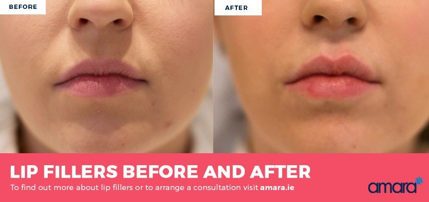 Lips Fillers Before and After Photos - Amara Clinics Dublin