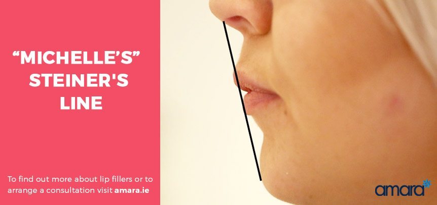 Steiner's Line - Lip Fillers Dublin