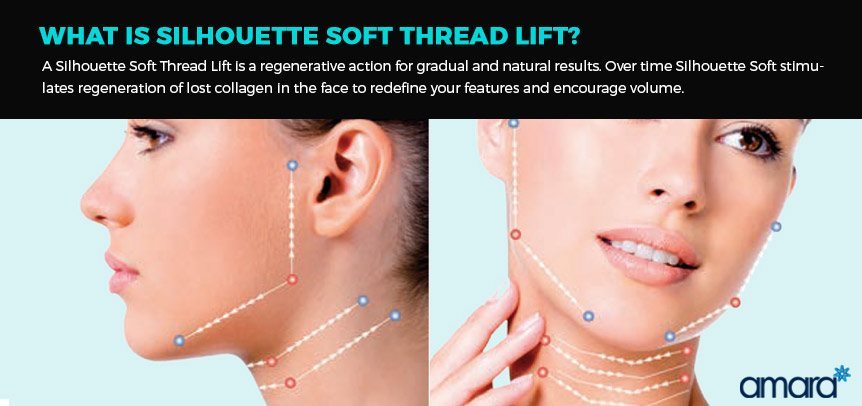 What Is Silhouette Thread Lift from Silhouette Soft - Amara Clinics