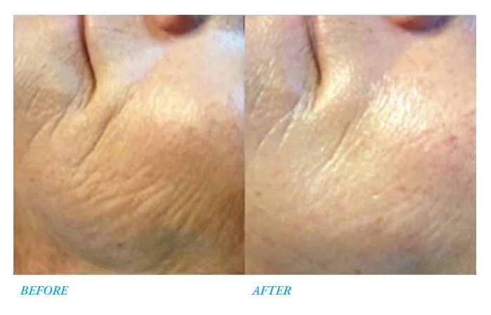 Rejuvapen Before After wrinkles