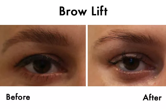 brow lift before after amara dublin