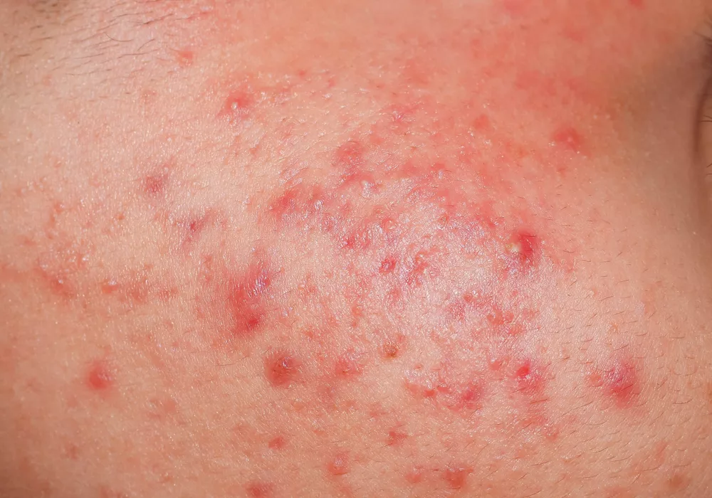 SS Acne Spots and Pimples