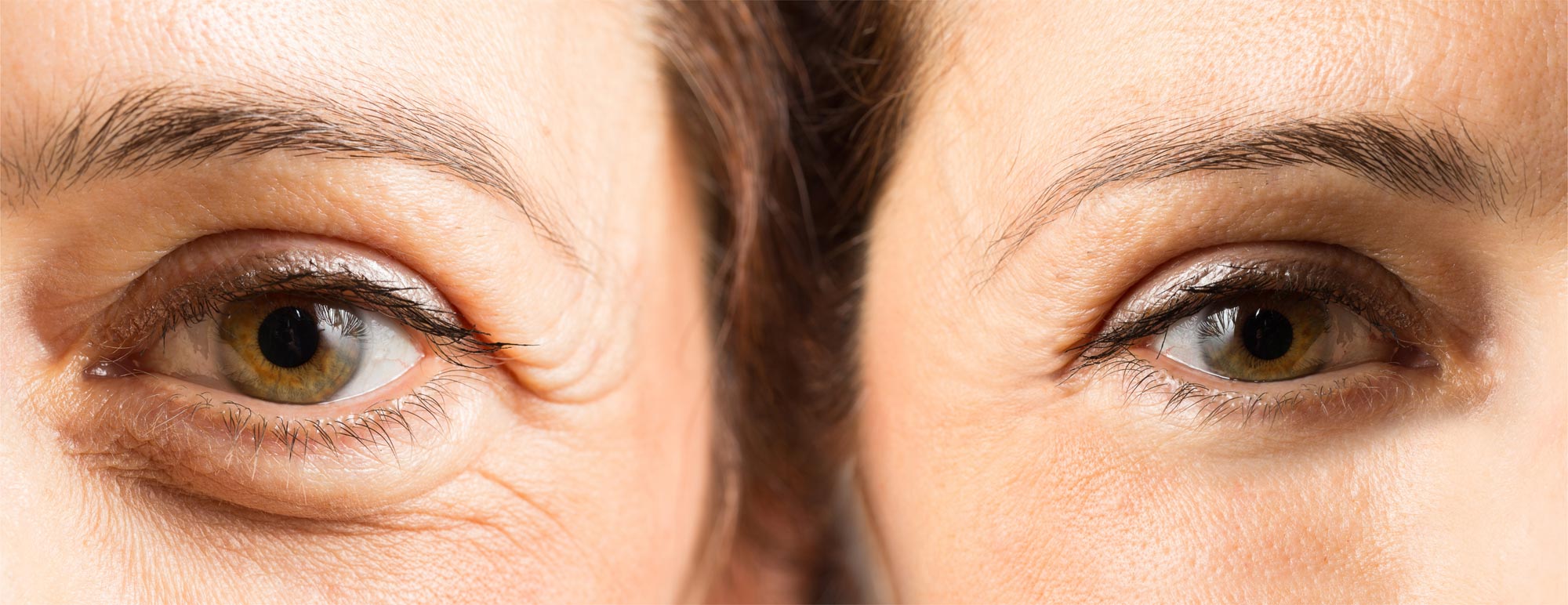 crow's feet lines, anti-wrinkle injections
