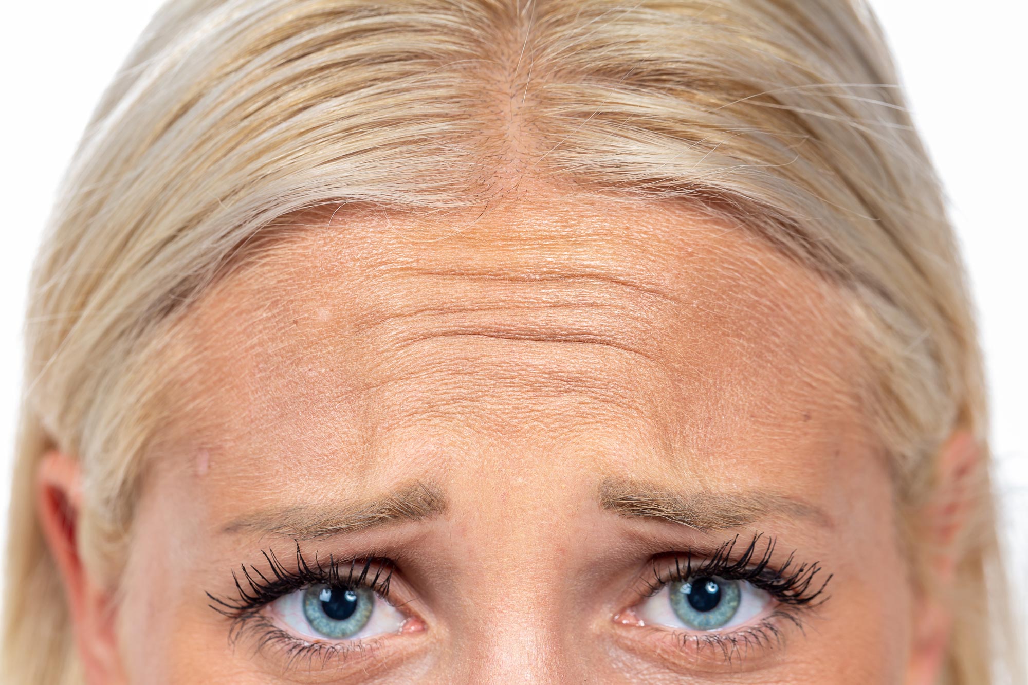 forehead-line-treatment-worry-lines-amara-clinic