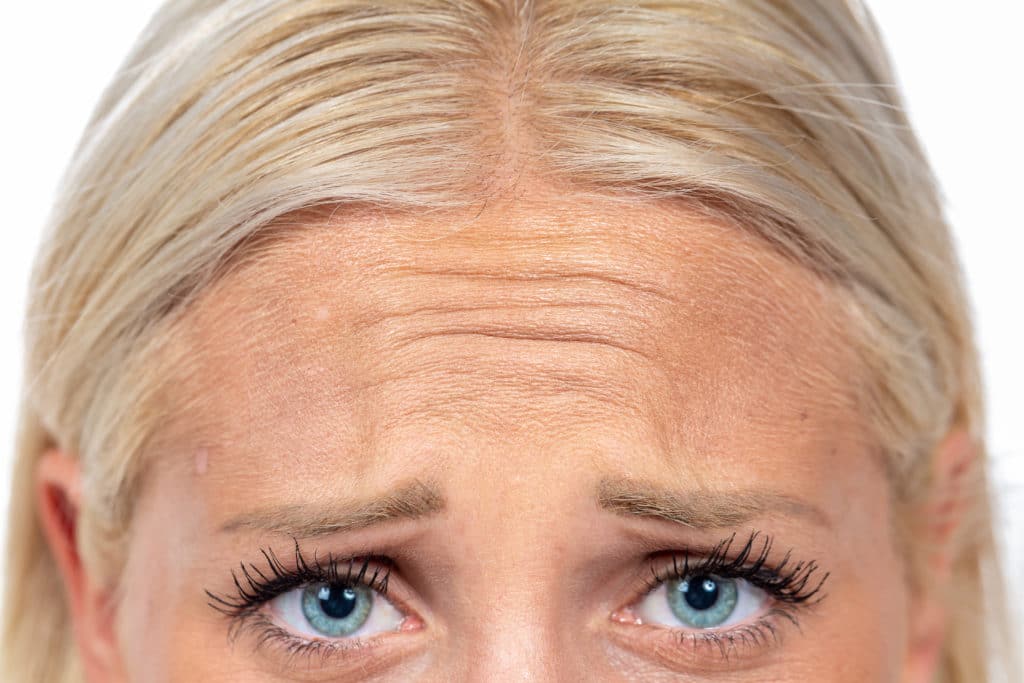 forehead-lines-worry-lines-amara-clinic-natural-subtle-results