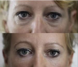 tear trough filler before and after picture