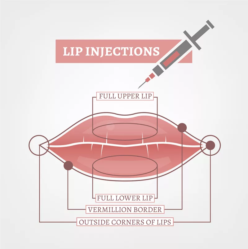 how-much-is-1ml-of-lip-filler-why-this-is-the-wrong-question-to-ask