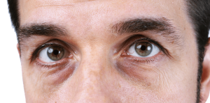 man with dark circles under eye
