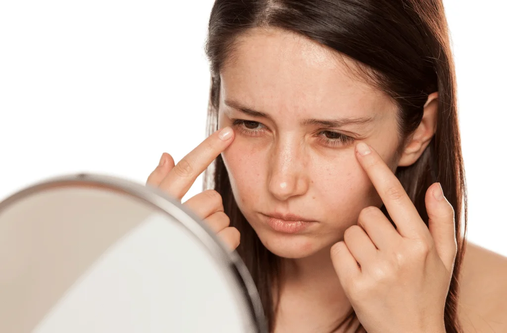 woman with dark under eye circles