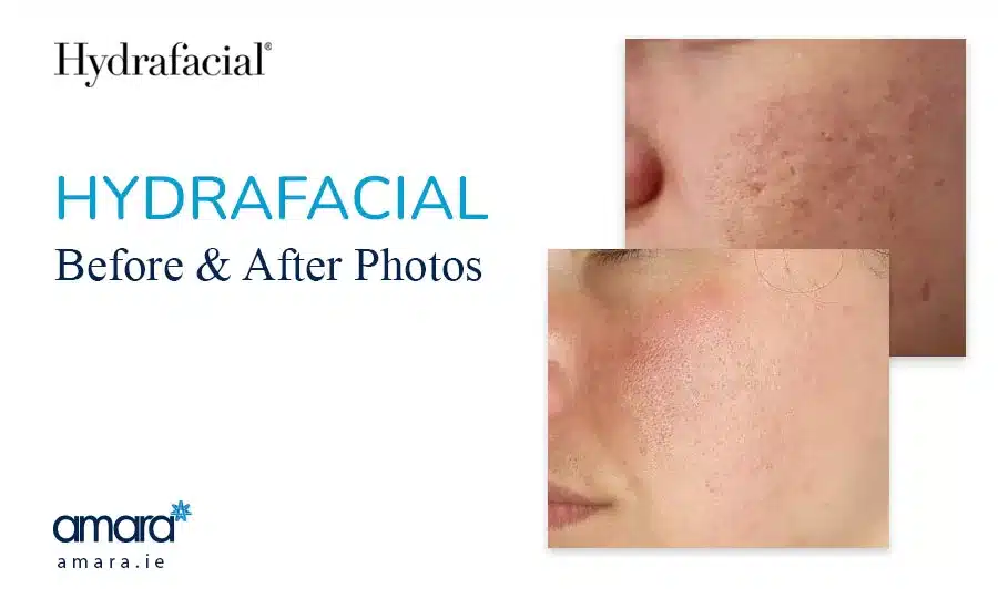Hydrafacial Before After Photos - Clinic Dublin Amara