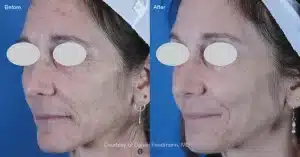 Before and after laser results