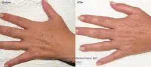 Before and After hand Laser IPL