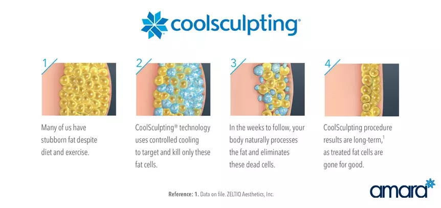 Coolsculpting-amara-dublin-fat-freezing-