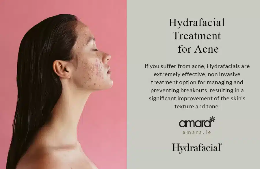 Hydrafacial Treatment Acne Dublin - Amara