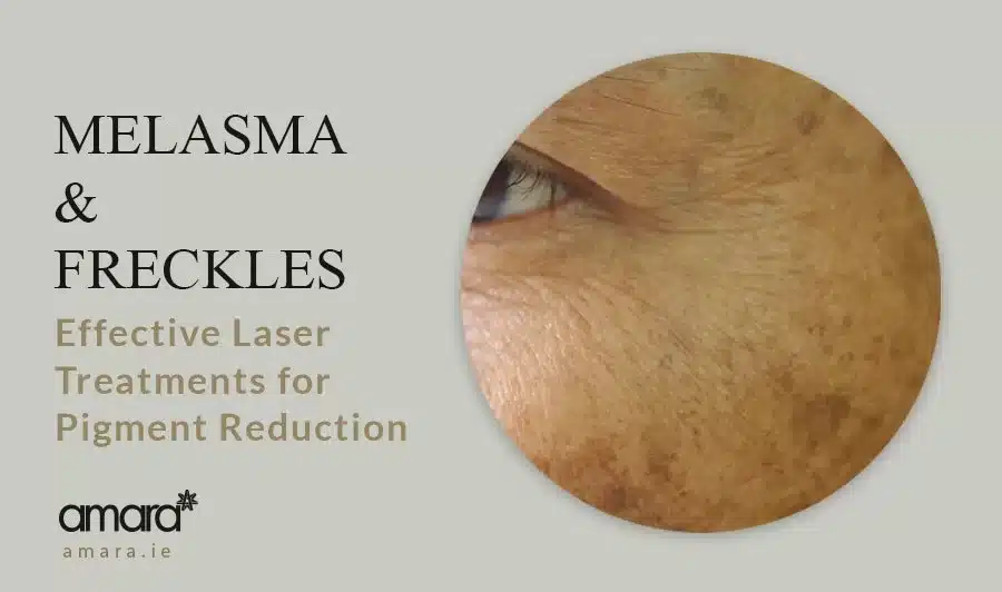 Melasma and Freckles Laser Treatment Pigment Reduction - Amara