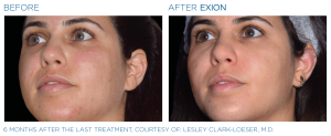 Exion Face results