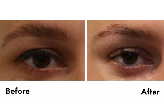 before_and_after_eyes